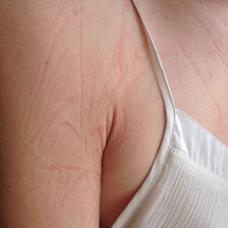 sleepmarks